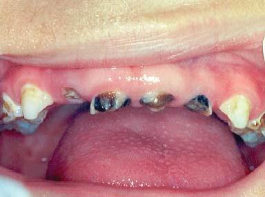 Photo image of teeth with caries disease