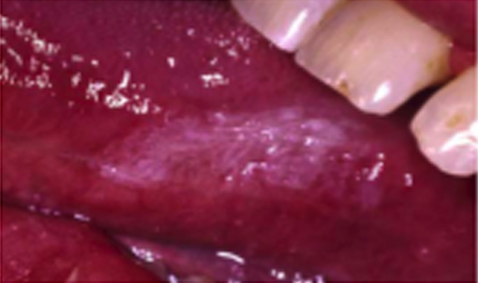 Hairy leukoplakia