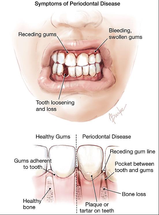 Symptoms of Periodontal Disease