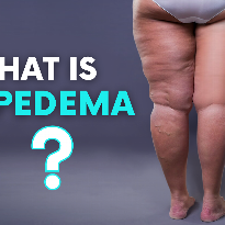 Lipedema