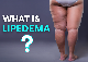 Lipedema