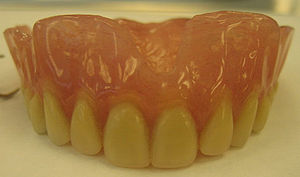 An Upper Complete Denture