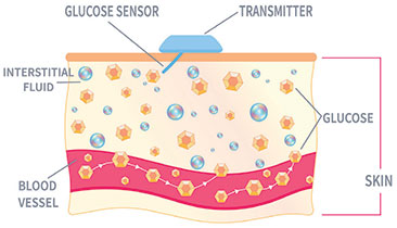 Continuous Glucose Monitor