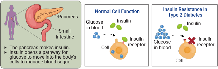Pancreas and small intestine diagram showing that the pancreas makes insulin, which helps glucose move into cells. Normal Cell Function - Insulin Resistance in Type 2 Diabetes