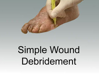 Thumbnail - clicking will open video - Simple Wound Debridement