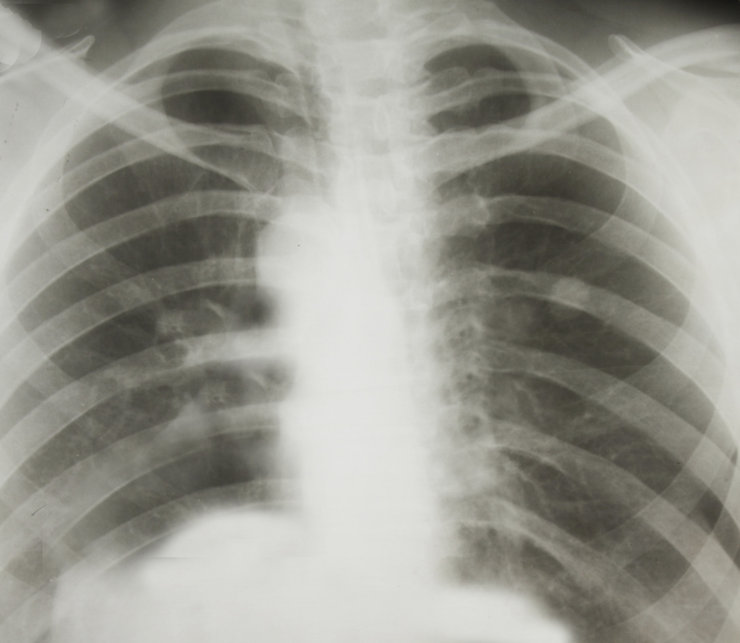 Chest x-ray